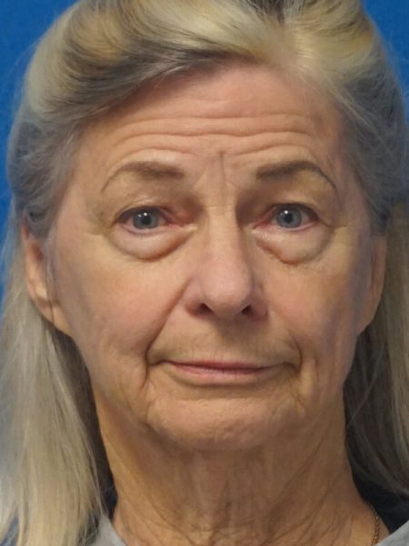 blepharoplasty p18 1a