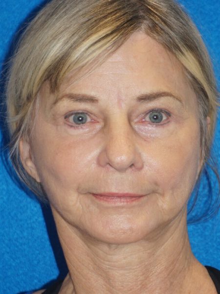 blepharoplasty p18 1b