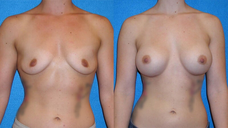 Breast Implant Patient in Sacramento