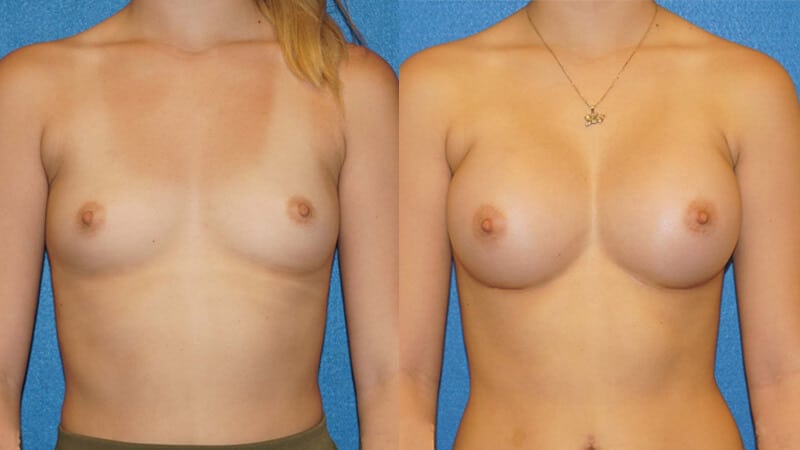 Breast Implant Before After in Sacramento