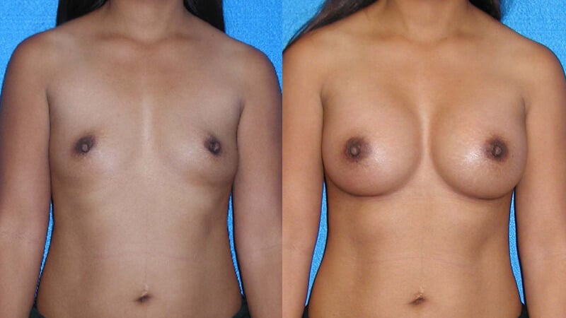 Breast Implant Before After in Granite Bay