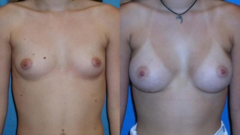 Breast Enlargement Patient Photo in Sacramento