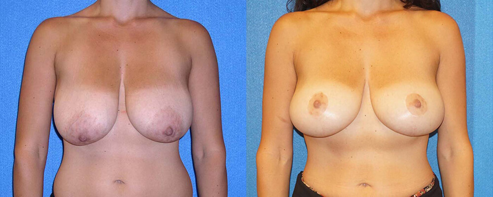 Breast Lift Patient in Sacramento