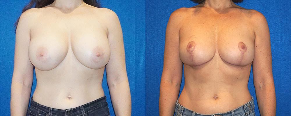 Breast Lift Before After in Sacramento