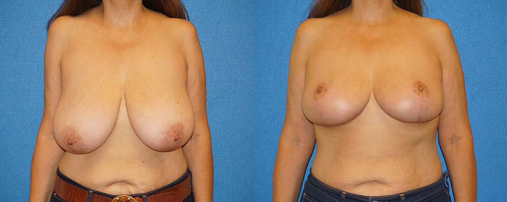 Breast Lift Before After in Granite Bay