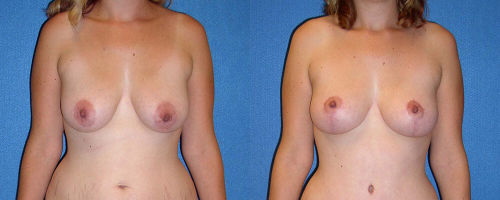 Breast Lift Patient Photo in Sacramento