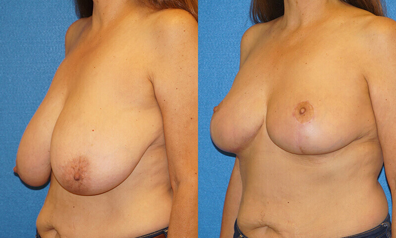 Breast Reduction Patient Photo in Sacramento