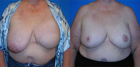 Breast Reconstruction Patient in Sacramento