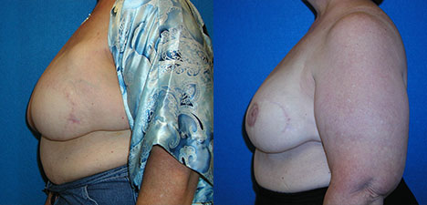 Breast Reconstruction Before After in Sacramento