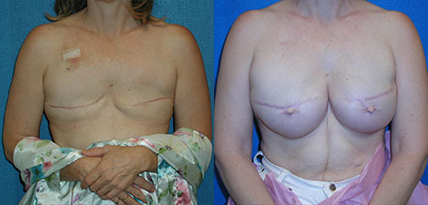 Breast Reconstruction Before After in Granite Bay
