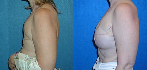 Breast Reconstruction Patient Photo in Granite Bay