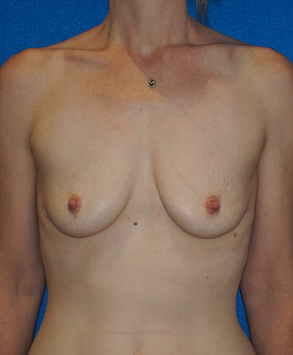 breast aug p118 1a