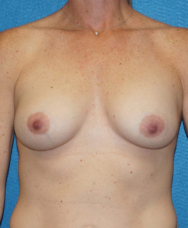 breast aug 119 after01