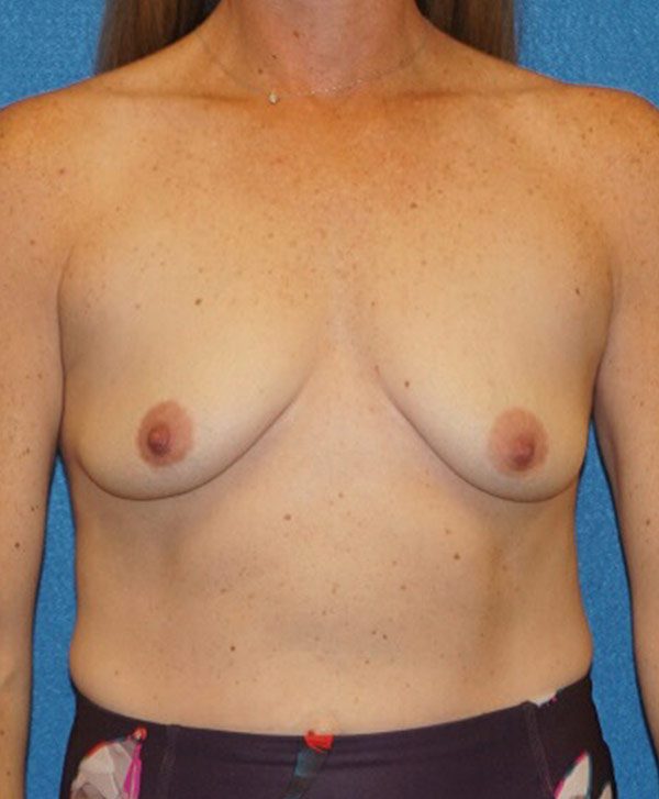 breast aug 119 before01