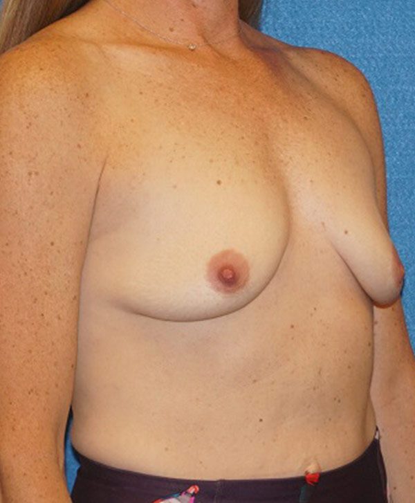 breast aug 119 before04