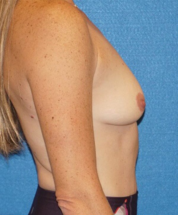 breast aug 119 before05