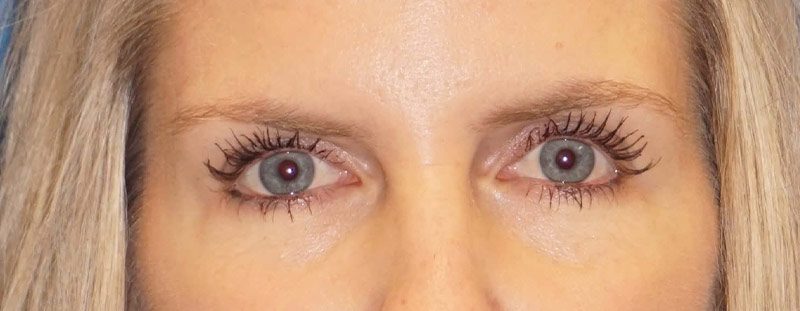 brow lift 23 before