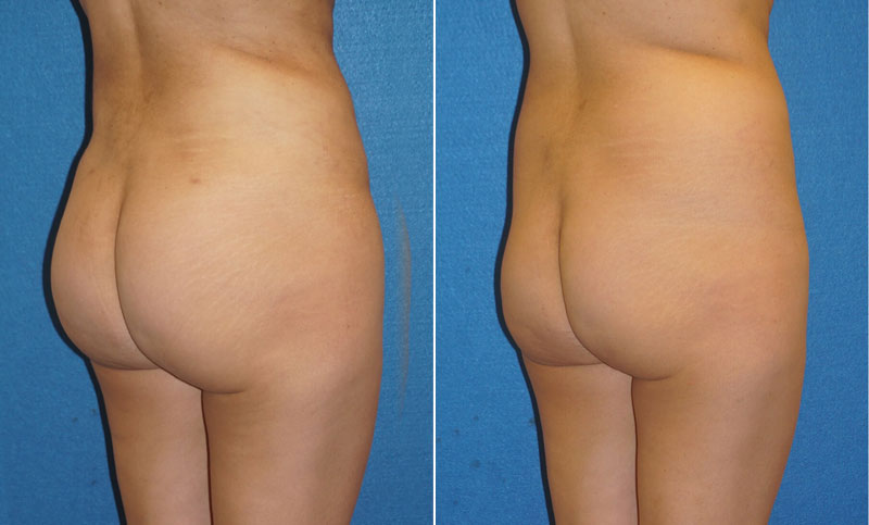 Butt Augmentation Patient Photo in Sacramento