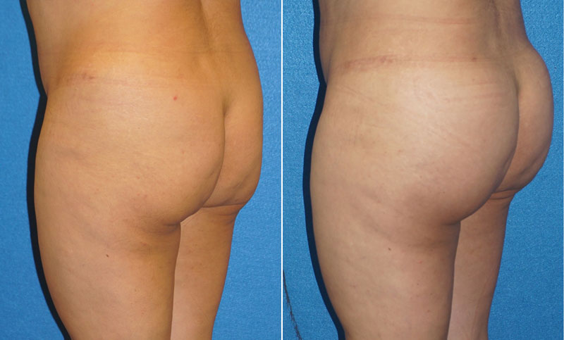 Butt Augmentation Before After in Granite Bay