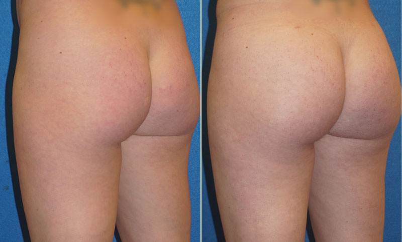 Butt Augmentation Before After in Sacramento