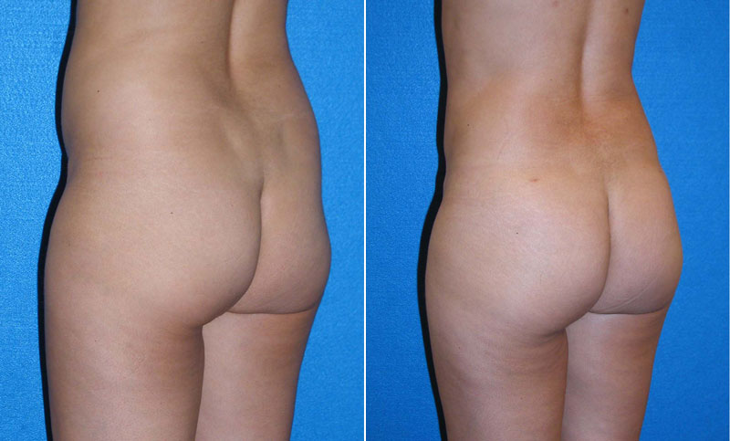 Butt Augmentation Patient in Sacramento