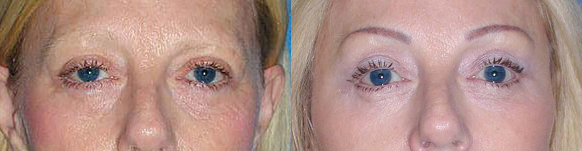 Brow Lift Patient in Sacramento