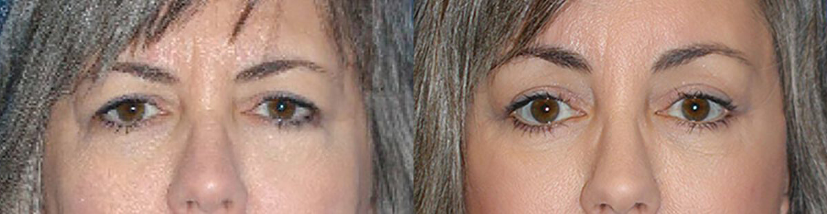 Brow Lift Before After in Sacramento