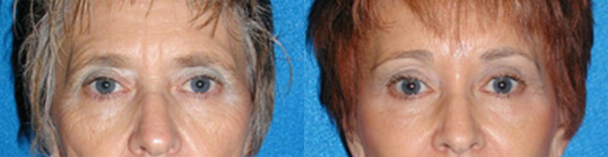 Brow Lift Before After in Granite Bay