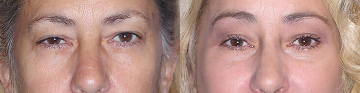 Brow Lift Before After in Granite Bay