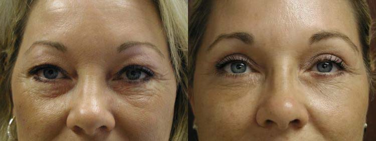 Eyelid Surgery Before After in Sacramento