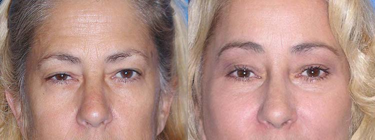 Blepharoplasty Before After in Sacramento