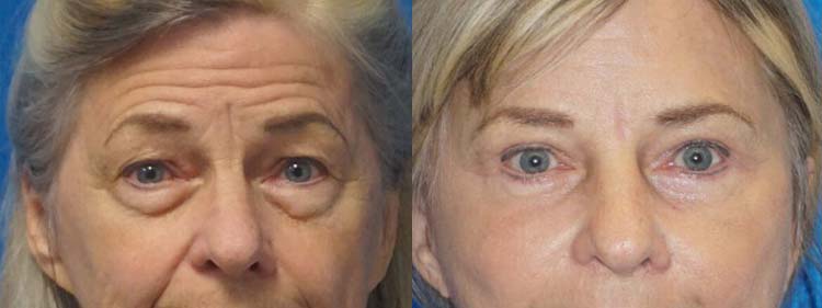 Eyelid Surgery Patient in Sacramento