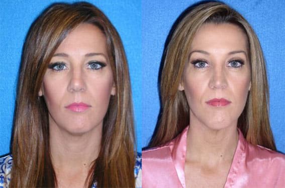 Chin Augmentation Before After in Sacramento & Granite Bay