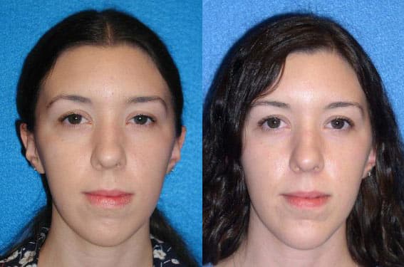 Chin Implant Patient in Granite Bay