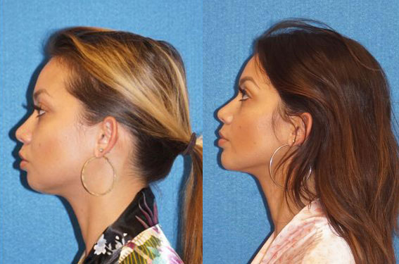 Chin Augmentation Before After in Sacramento