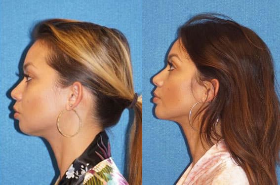 Chin Augmentation Before After in Sacramento