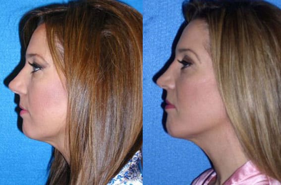 Chin Implant Patient in Sacramento