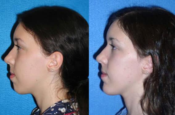 Chin Implant Patient Before After in Sacramento