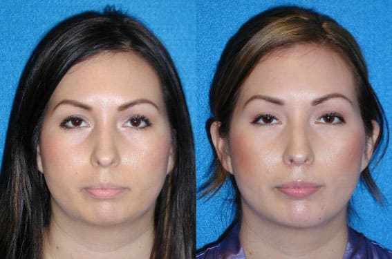 Chin Augmentation Patient in Granite Bay