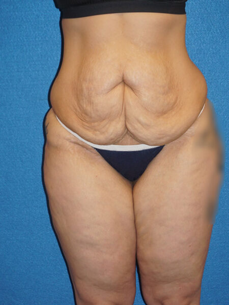 abdominoplasty patient 67a
