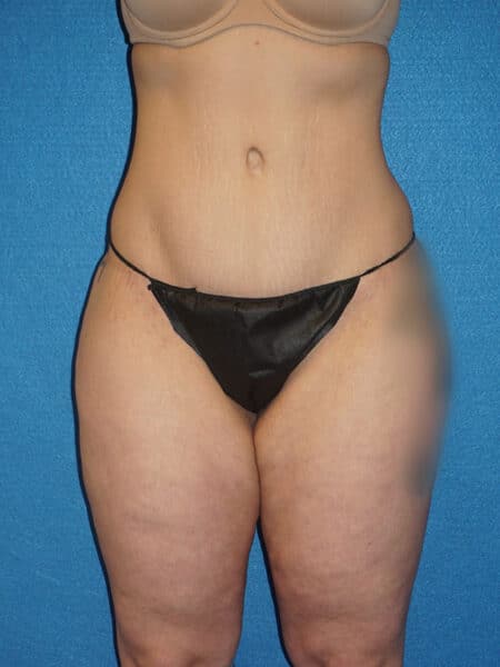 abdominoplasty patient 67b