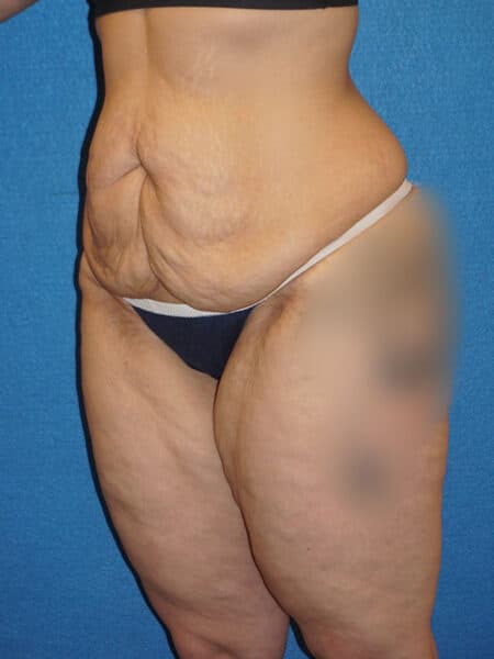abdominoplasty patient 67c