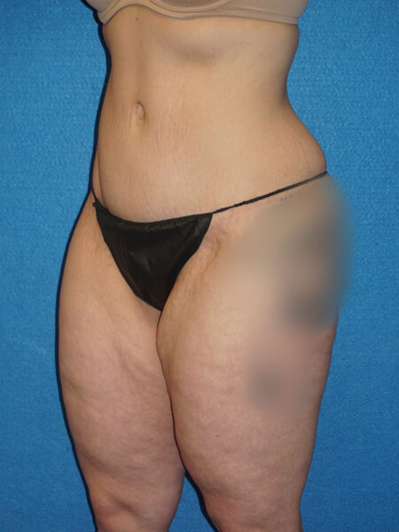 abdominoplasty patient 67d