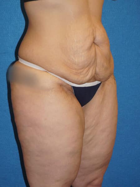 abdominoplasty patient 67g