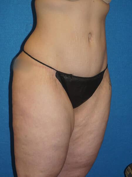 abdominoplasty patient 67h