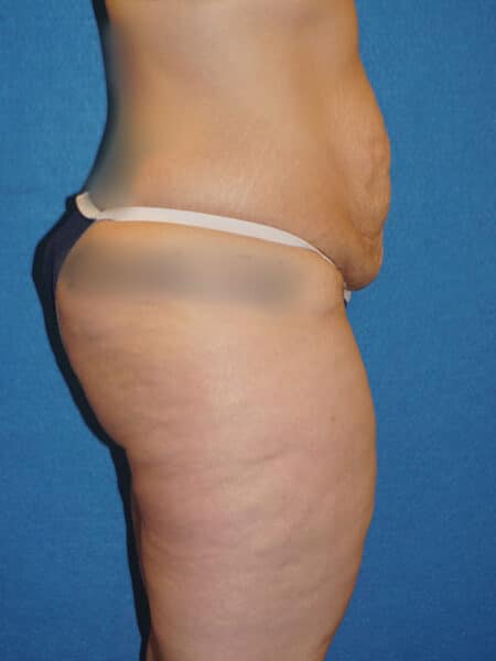 abdominoplasty patient 67i