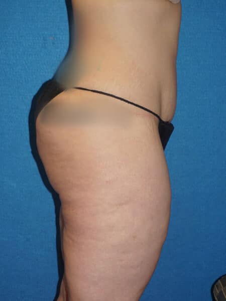 abdominoplasty patient 67j
