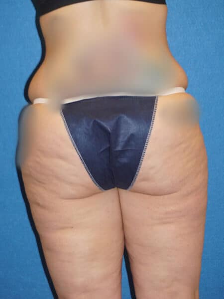 abdominoplasty patient 67k