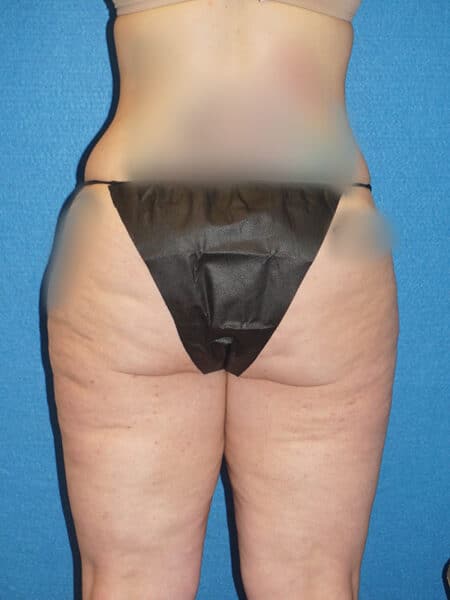 abdominoplasty patient 67l