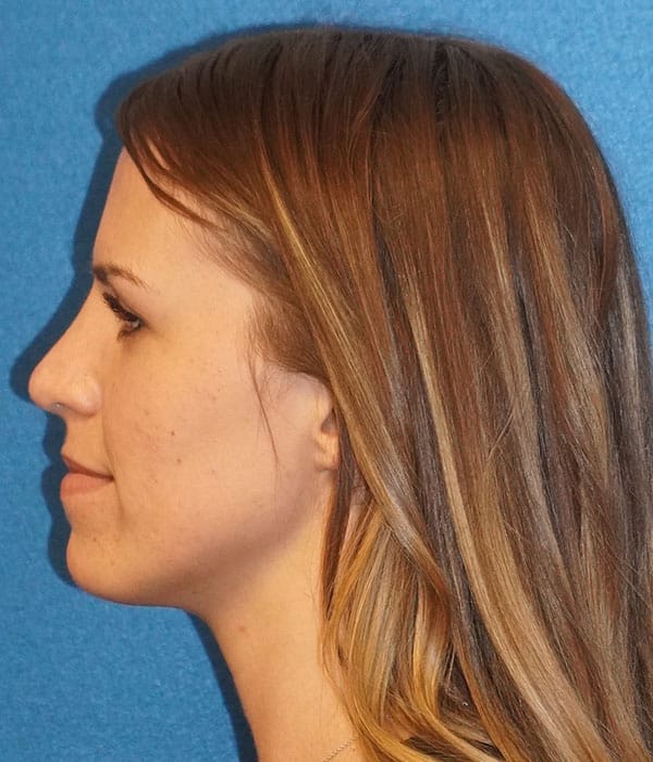 rhinoplasty patient 27f